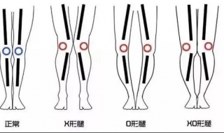 小腿不直怎么办（小腿不直怎么办?）