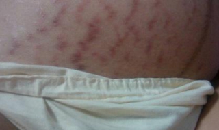 妊娠纹怎么办（肚子有妊娠纹怎么办）