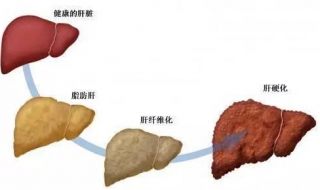 脂肪肝怎么办（脂肪肝怎么办吃什么能降脂肪）