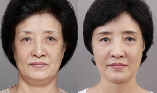 皮肤松弛了怎么办（生完孩子皮肤松弛了怎么办）