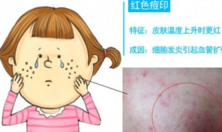 痘印怎么办（脸上有痘印怎么办）