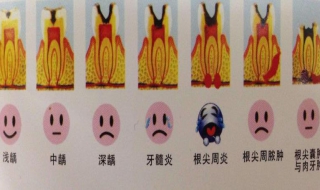 牙髓炎怎么办 牙髓炎怎么快速止痛