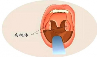 扁桃体有炎症怎么办（扁桃体有炎症怎么办）