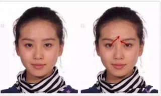 斜视怎么办 有点斜视怎么办