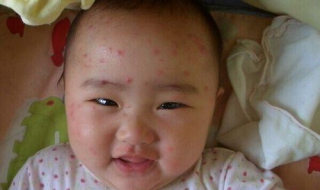 小孩起水痘怎么办（小孩出水痘怎么办?应该注意哪一点?）
