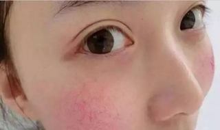 面部有红血丝怎么办（面部有红血丝怎么修复）