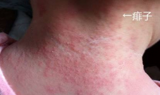 孩子起痱子怎么办 三岁孩子起痱子怎么办