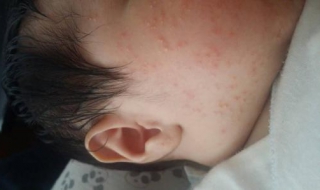婴儿脸上湿疹怎么办 婴儿脸上湿疹怎么办好得快