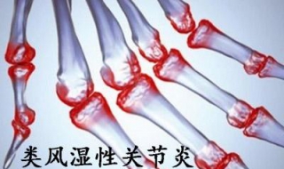 类风湿什么不能吃（类风湿什么不能吃?）