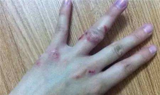 湿疹不能吃什么（湿疹不能吃什么蔬菜及水果）