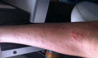 慢性荨麻疹不能吃什么（慢性荨麻疹不能吃什么,要忌些什么东西?）