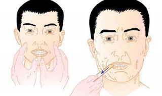 咀嚼肌大怎么办（咀嚼肌很大怎么办）