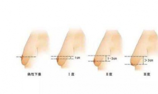 乳房下垂松软怎么办（女人乳房下垂松弛怎么办）