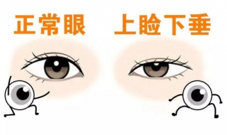 上睑下垂怎么办（上睑下垂怎么改善）