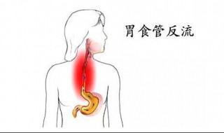 胃食管反流的两大症状 胃食管反流的两大症状是什么