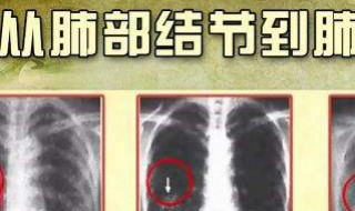 肺结节拍打方法 肺结节拍打方法视频