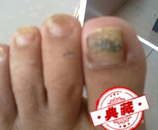 指甲变黑是怎么回事啊（指甲有变黑怎么回事）