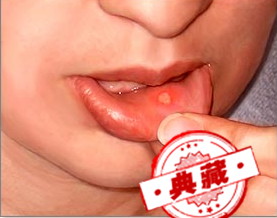 口腔溃疡的治疗方法 口腔溃疡的治疗方法维生素B2