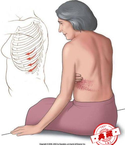 带状疱疹的治疗方法（带状疱疹治疗方法）