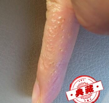 手上起水泡很痒怎么办 手上起水泡很痒怎么办用什么药