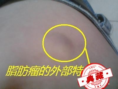 怎样预防脂肪瘤 怎样预防脂肪瘤增多增大