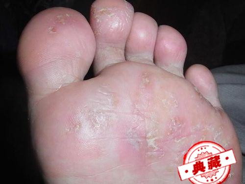 如何治疗脚气呢 如何治疗脚气呢图片