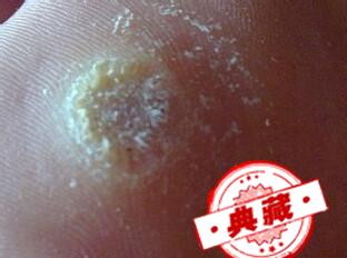 鸡眼和跖疣怎么区别 鸡眼和跖疣怎么区别图片
