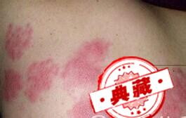 水痘的症状和治疗（水痘的症状和治疗一般几天能好）