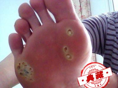 跖疣治愈——我的亲身路程 跖疣能治愈吗