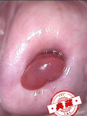 宫颈息肉的症状及食疗 宫颈息肉的症状及治疗