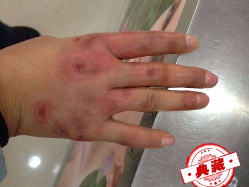 长冻疮了怎么治疗和预防 长冻疮怎么预防和根治