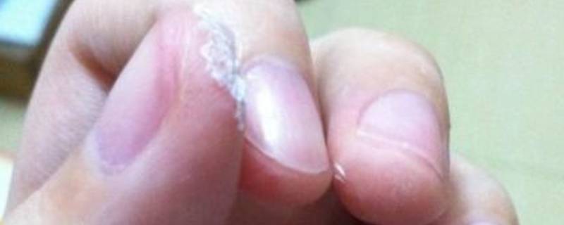 焊接剂胶水粘到手怎么办（被焊接剂粘到手怎么办）