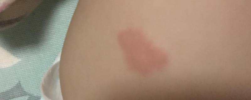 胎记的由来（胎记有几种类型图片）