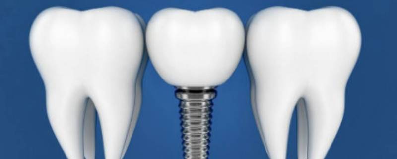 士卓曼种植体是哪国的（士卓曼种植牙多少钱一颗）